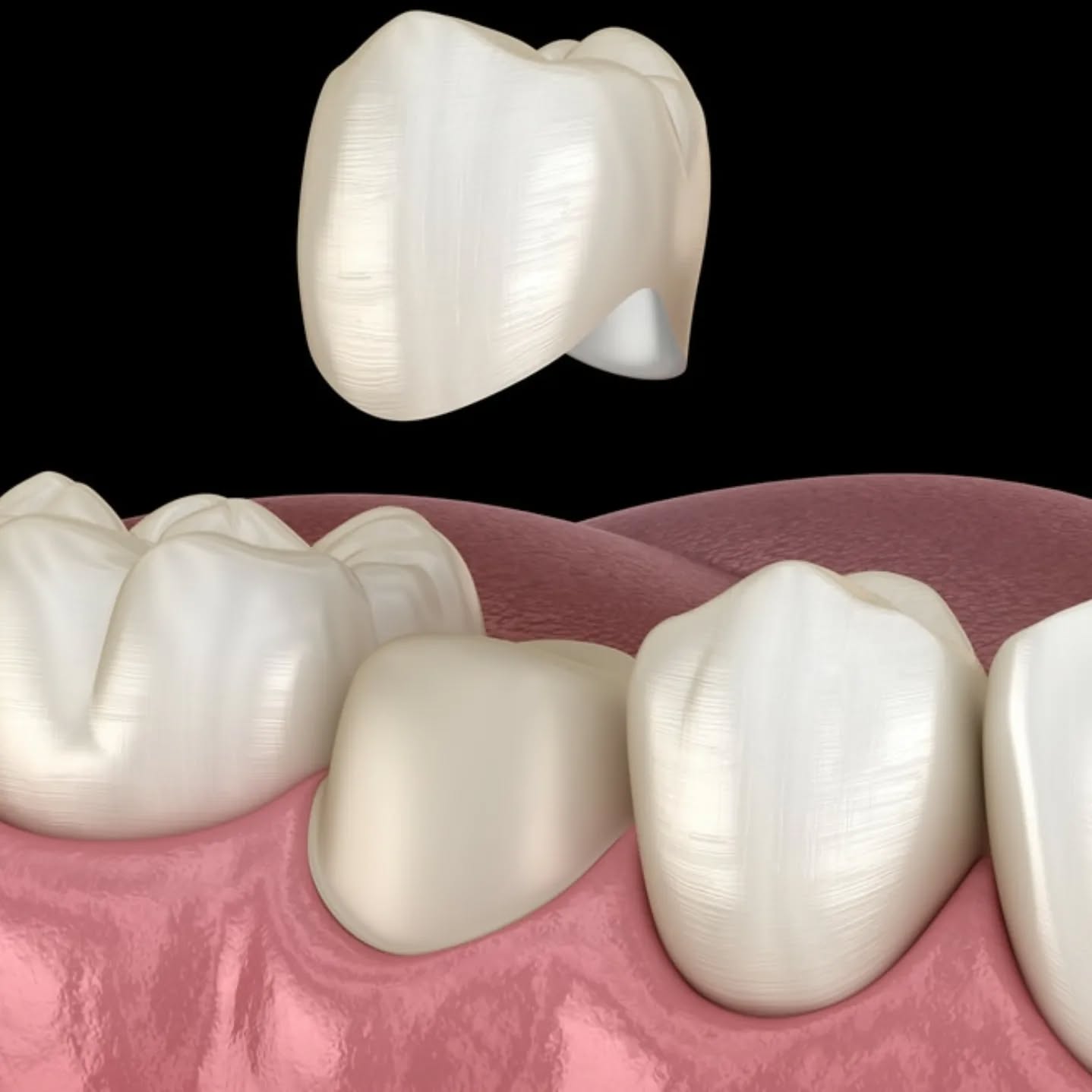 Ilustração de coroa sobre dente tratado de canal