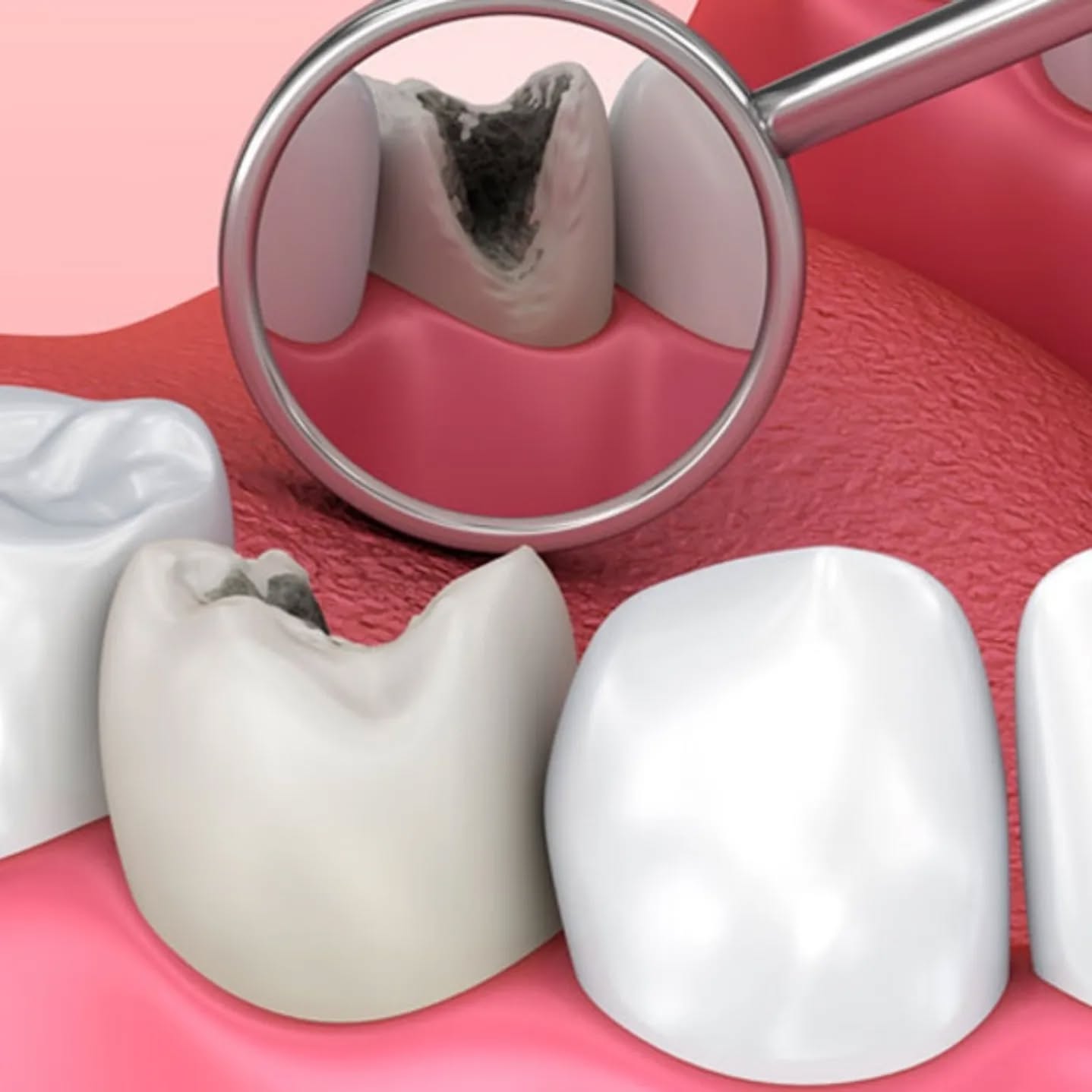 Ilustração de dente com cárie e fratura