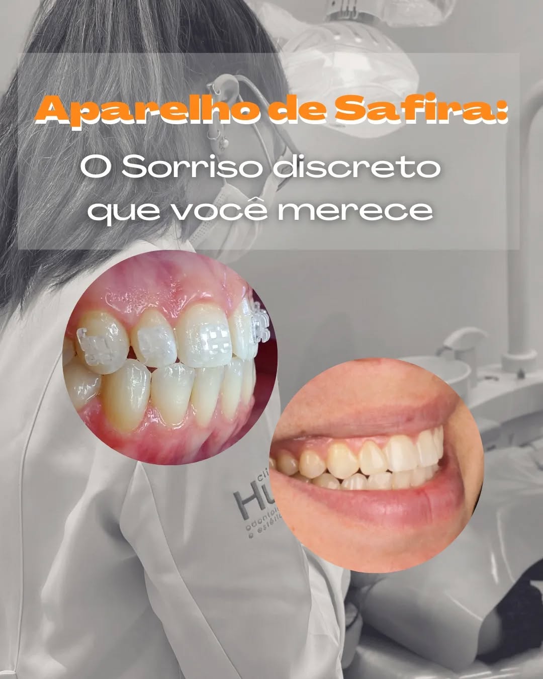 Aparelho de safira: o sorriso discreto