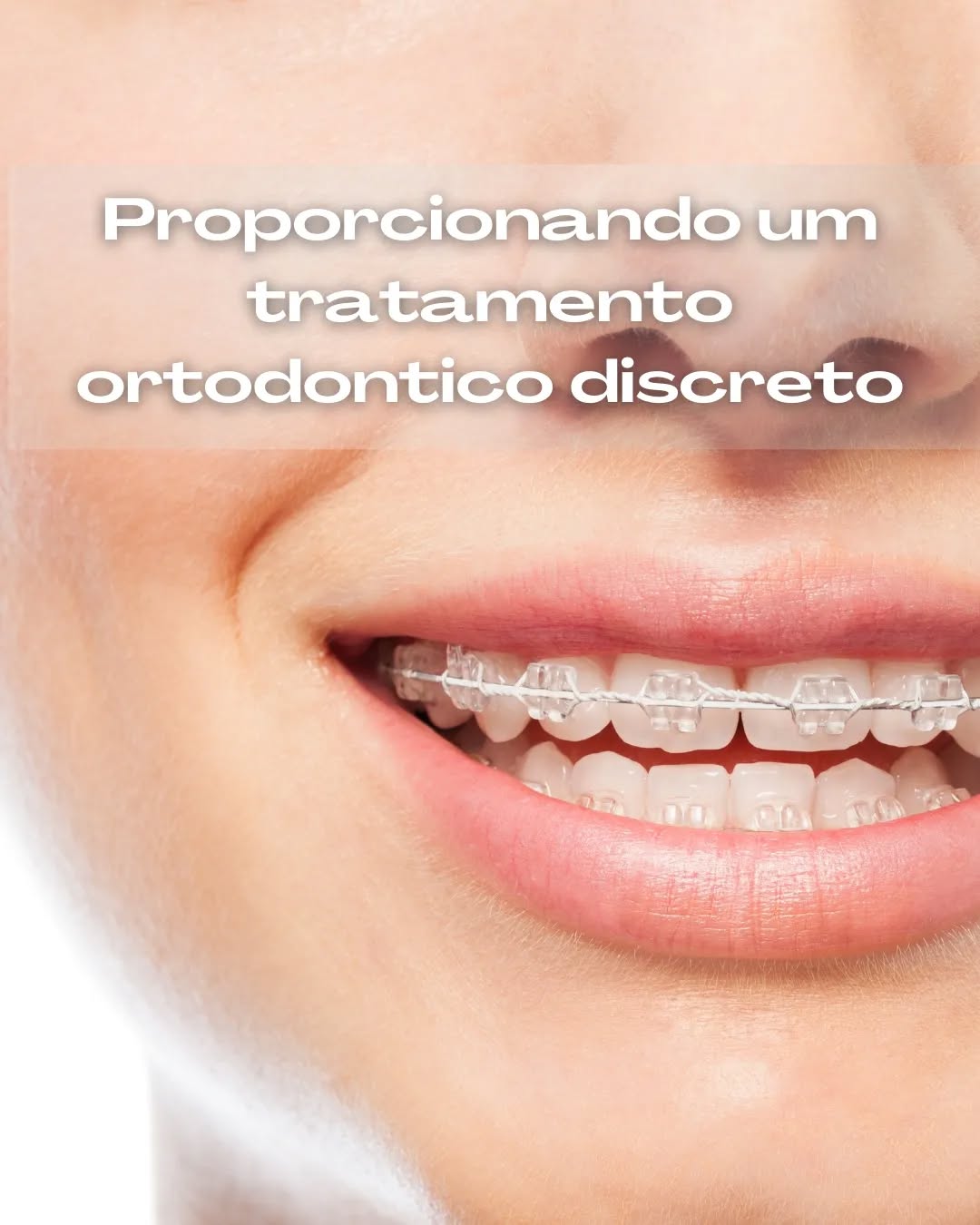 Tratamento ortodôntico discreto com aparelho de safira