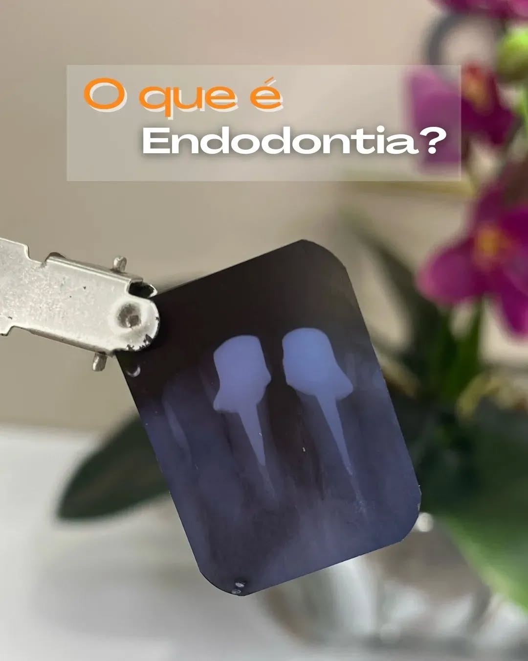 O que é endodontia: radiografia de dentes tratados