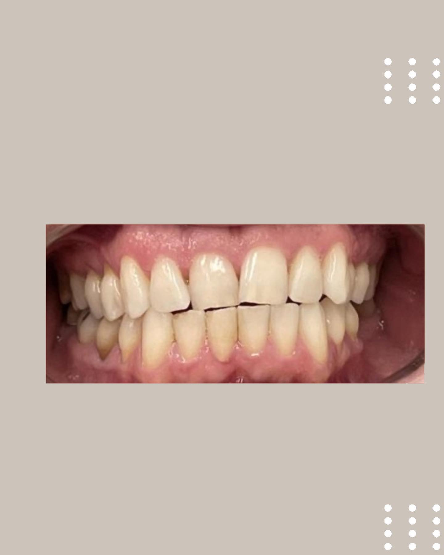 Antes e depois de tratamento com Invisalign