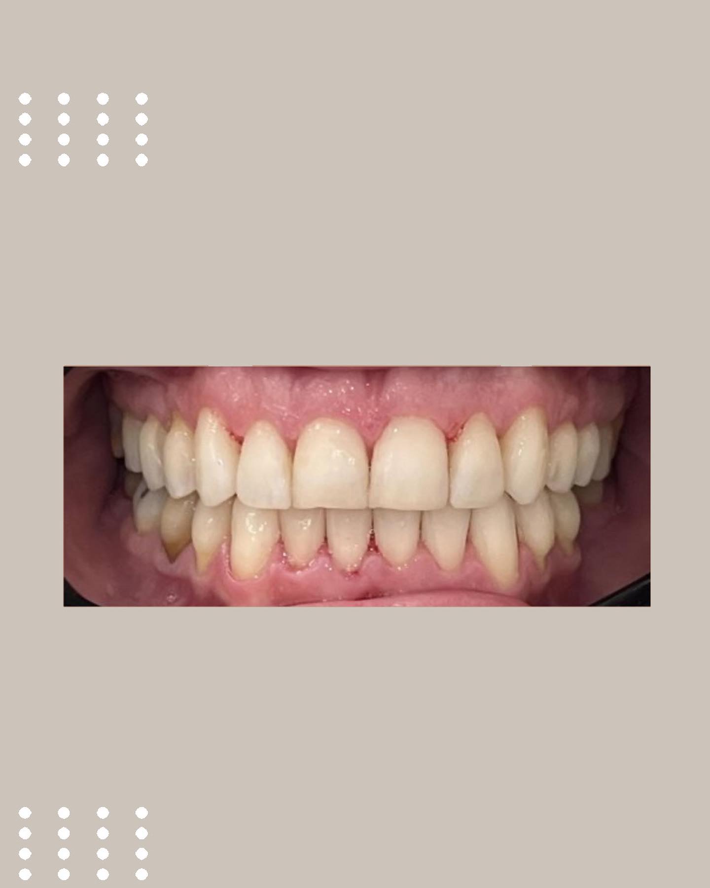 Antes e depois de tratamento com Invisalign