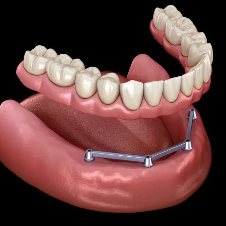 Ilustração de overdenture sobre implantes