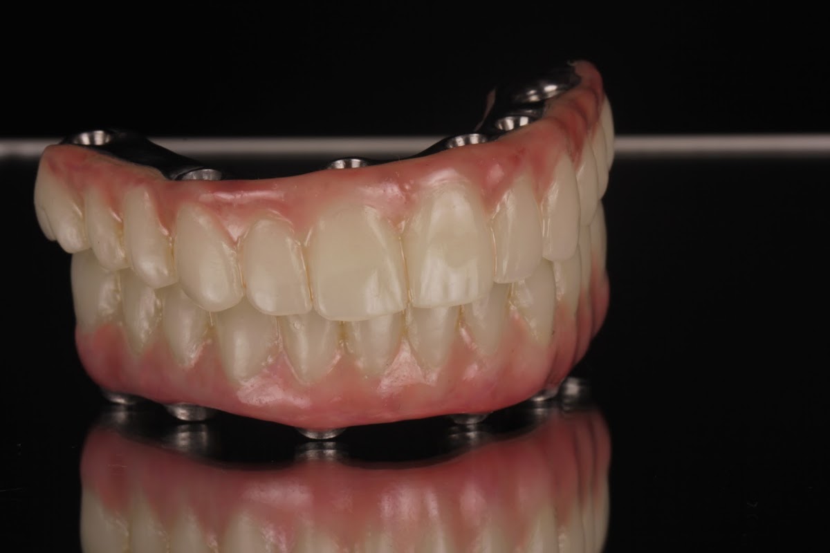 Detalhe de prótese protocolo sobre implantes