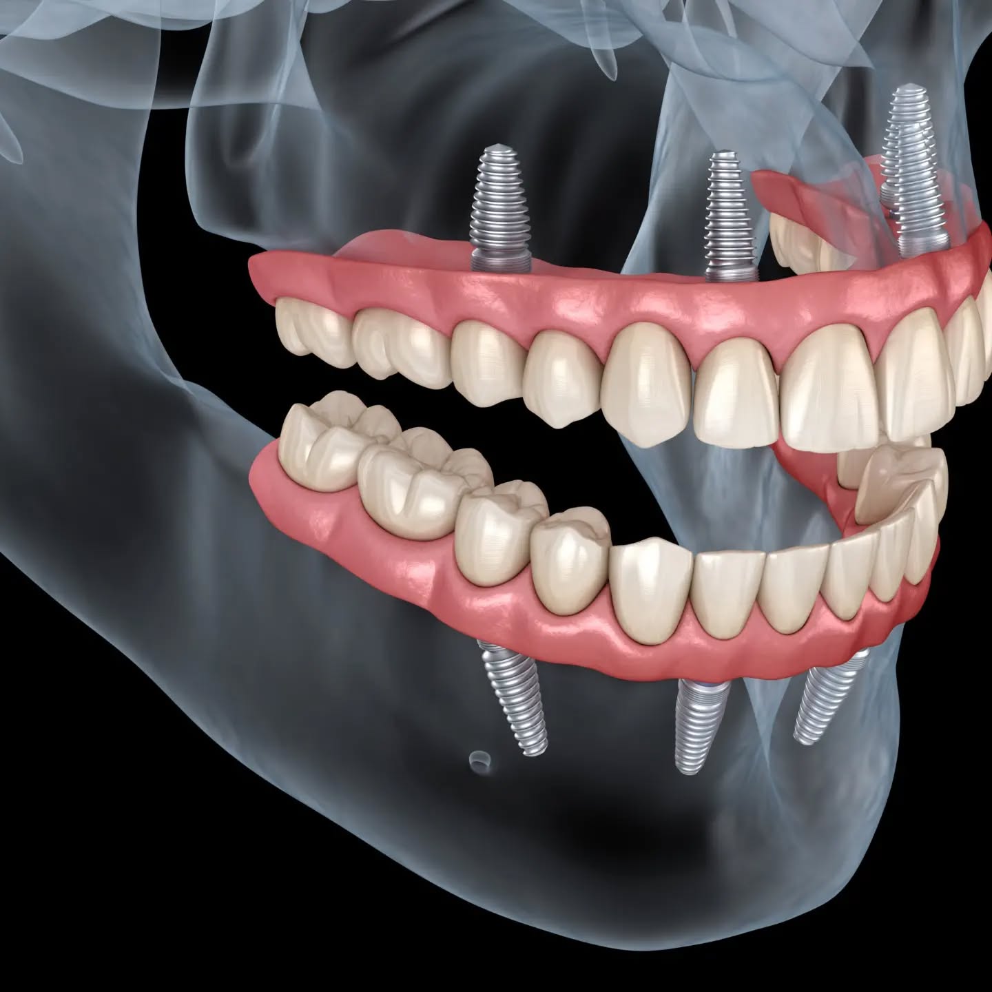 Ilustração de prótese protocolo sobre implantes